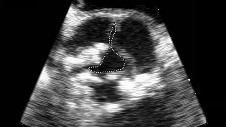 echocardiogram image of the heart with dotted white line tracing