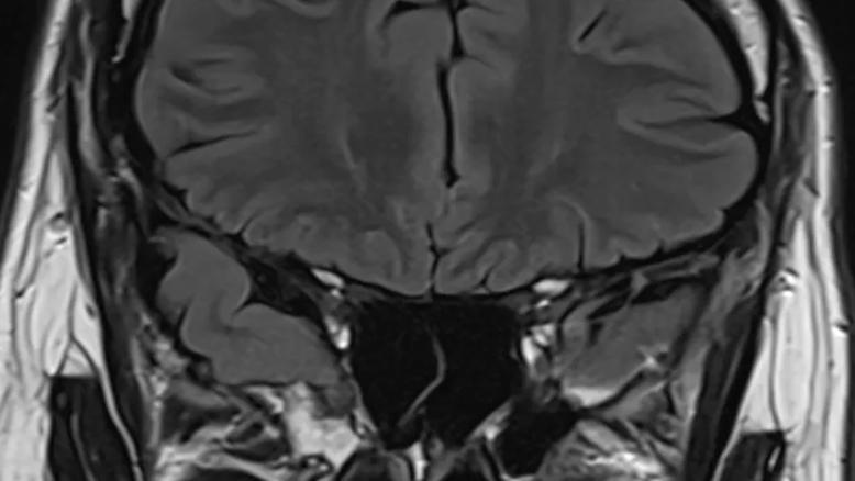 brain MRI taken from the back of the head