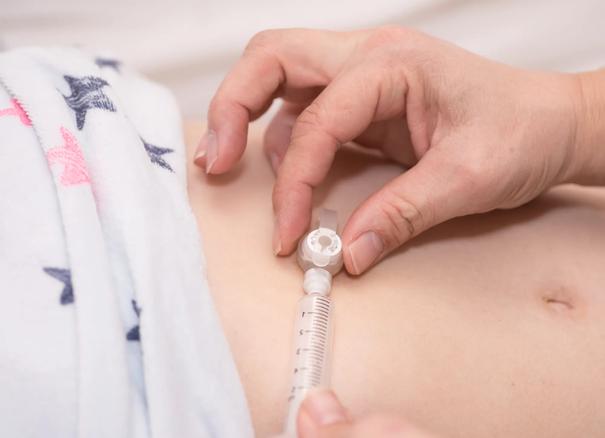 image of stomach feeding tube
