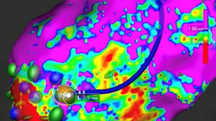 map of the heart for use in cardiac ablation with catheter atop the map