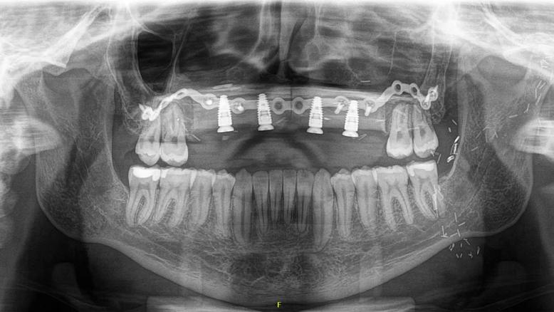 Panoramic radiograph showing the completed midface reconstruction