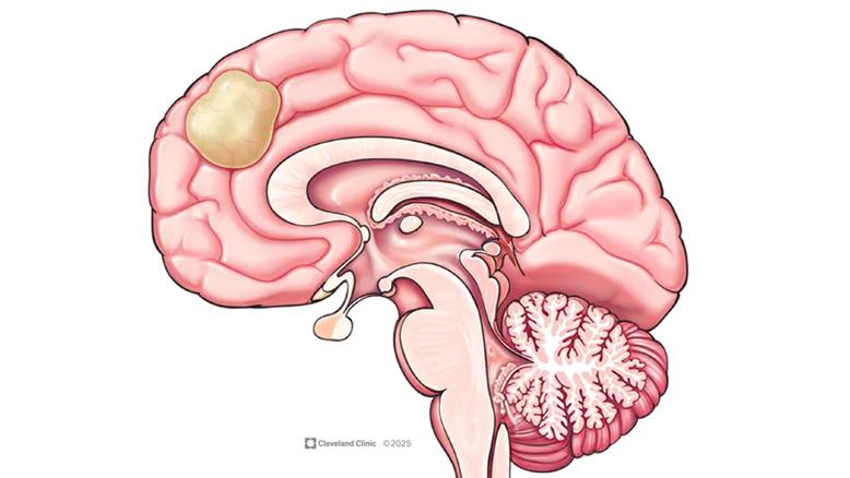 illustration of human brain with rumor at top right