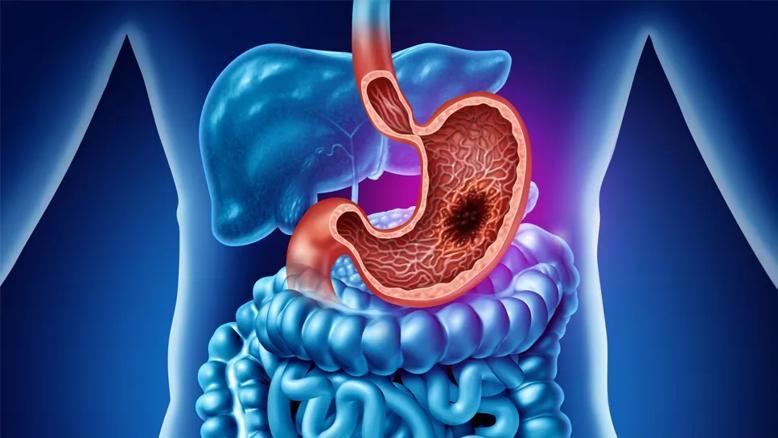 gastroesophageal cancer illustration
