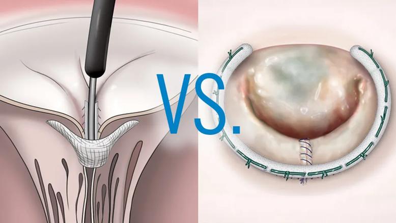 illustrations of two valve procedures with "Vs." overlay spanning them