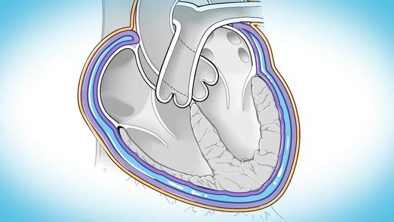 heart illustration showing pericarditis