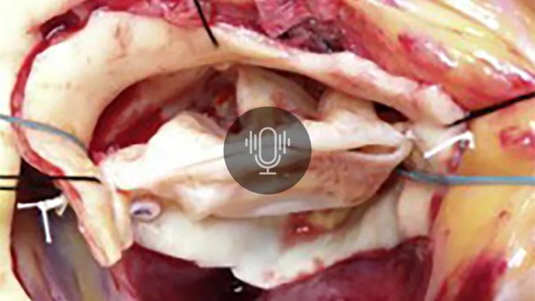 exposed heart valve during open heart surgery, with podcast button overlay