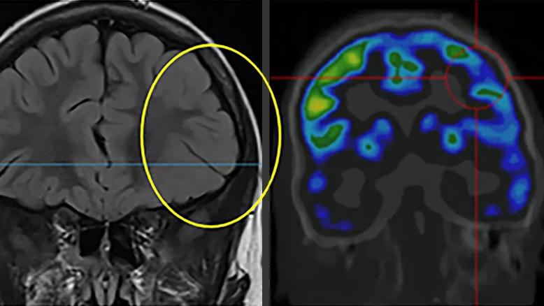 two brain scans side by side with a yellow circle on the left scan