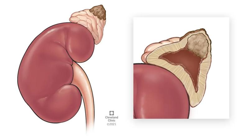 medical illustration of a pheochromocytoma