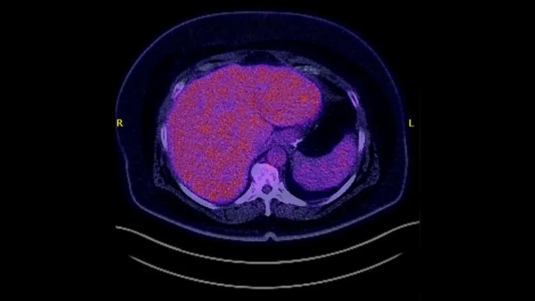 PET scan after CAR T-cell therapy