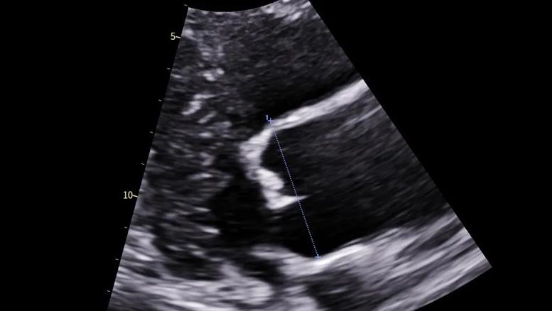 Dilated aorta