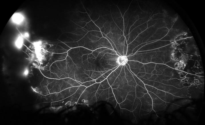 Fluorescein angiography image of leaking blood vessels