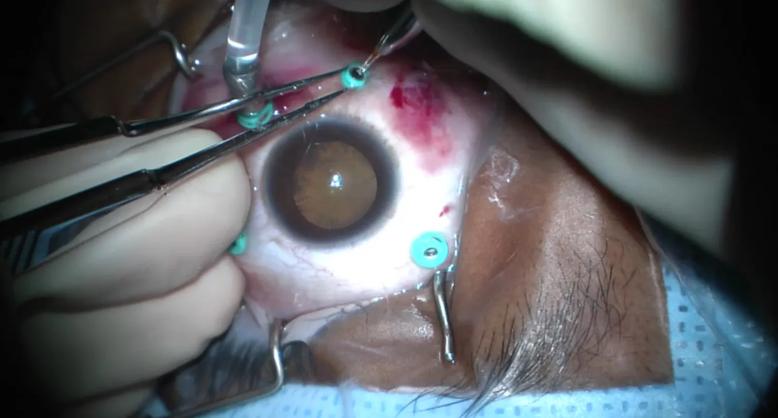 Surgery for diabetic tractional retinal detachment