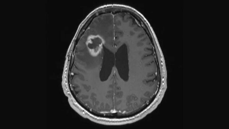 brain scan showing a large white-rimmed lesion in top left portion