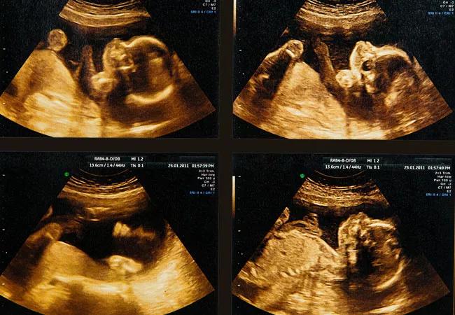 Fetal ultrasound image