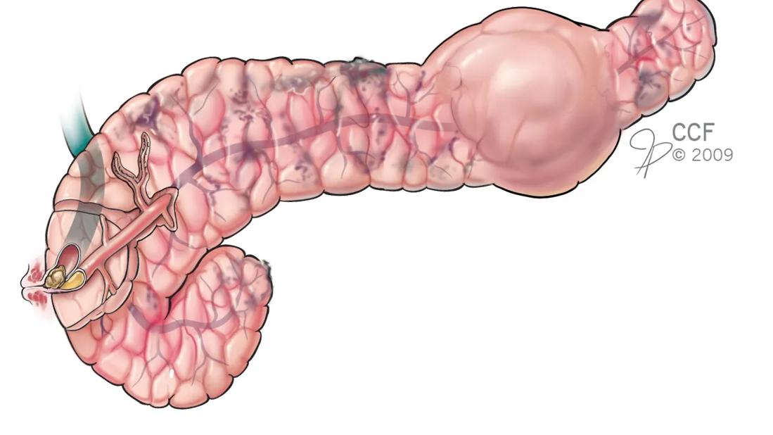 Pancreatitis