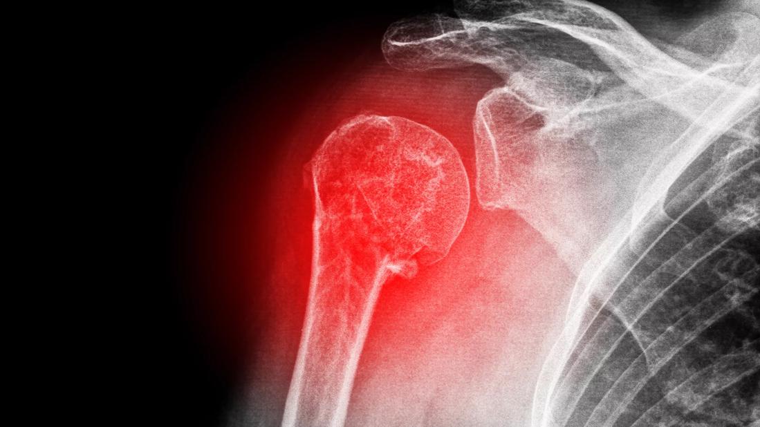 Treatment advances for frozen shoulder