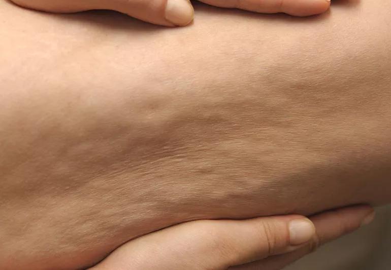 closeup of a person's leg showing cellulite