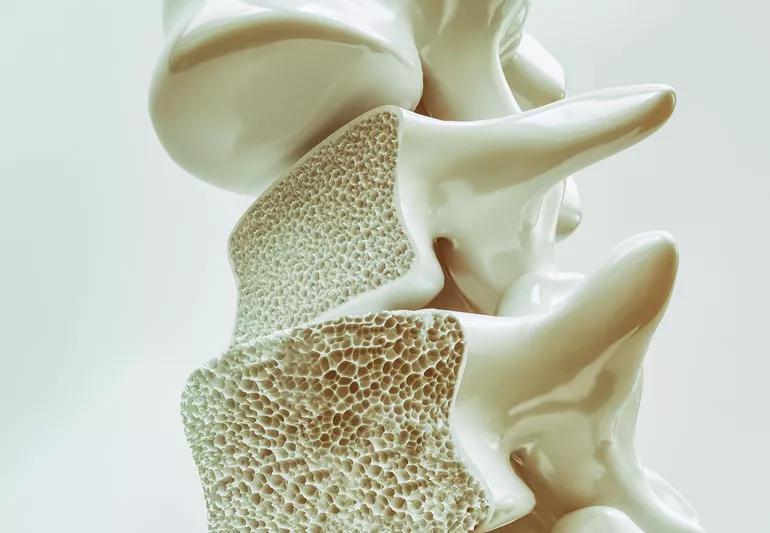 Example of spine with osteoporosis