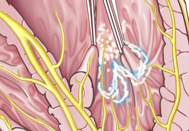 A New Noninvasive Tool for Refractory Ventricular Tachycardia?