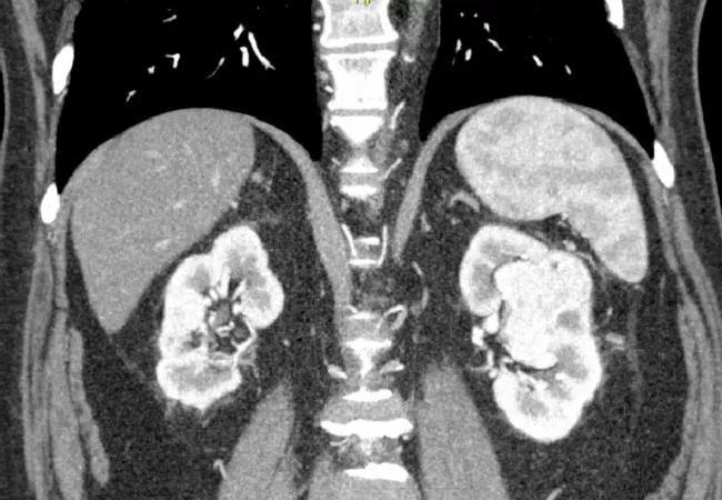 Renal-Cell-Carcinoma_650x450