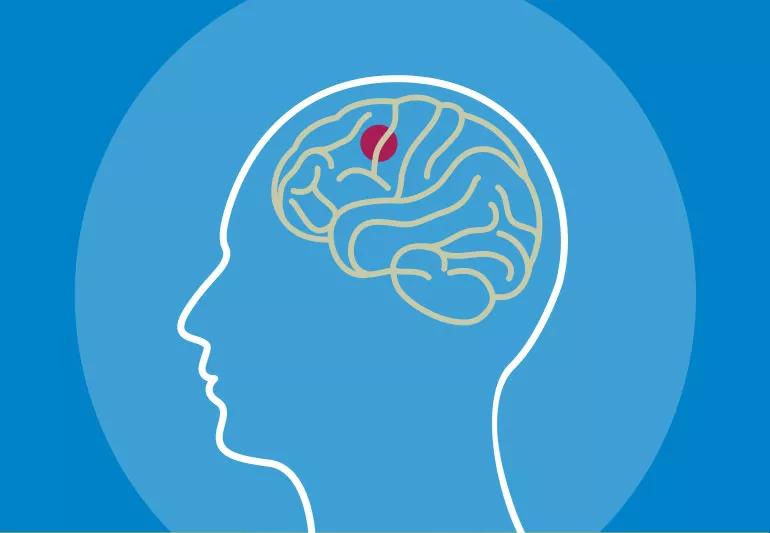 Illustration of glioblastoma in brain