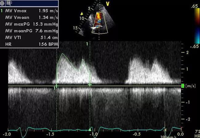 19-HRT-6007-mitral-valve-echo-650&#215;450