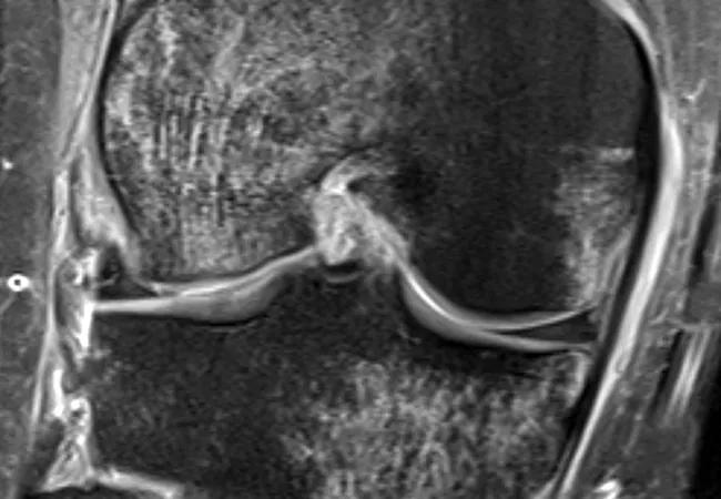 MRI showing bone bruises