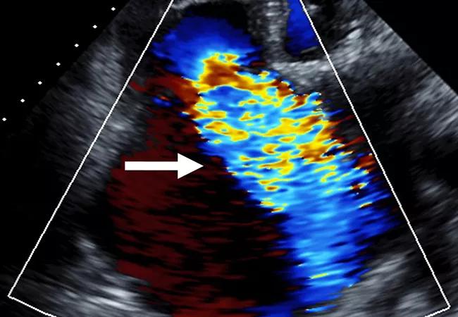 23-HVI-4078932_severe-tricuspid-regurgitation_650x450