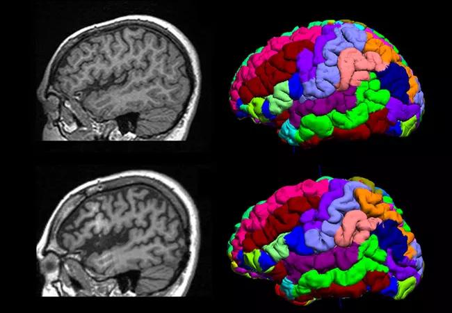 18-NEU-509-Nakamura-Volumetric-MRI-650&#215;450