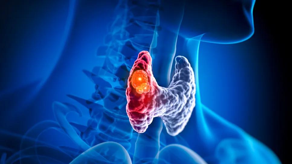 Hurthle cell carcinoma