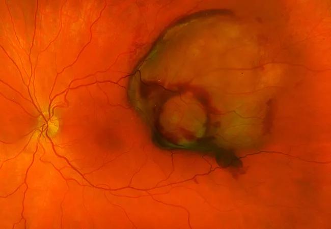 21-EYE-2340059 CQD Cured fractions of uveal melanoma_Arun Singh