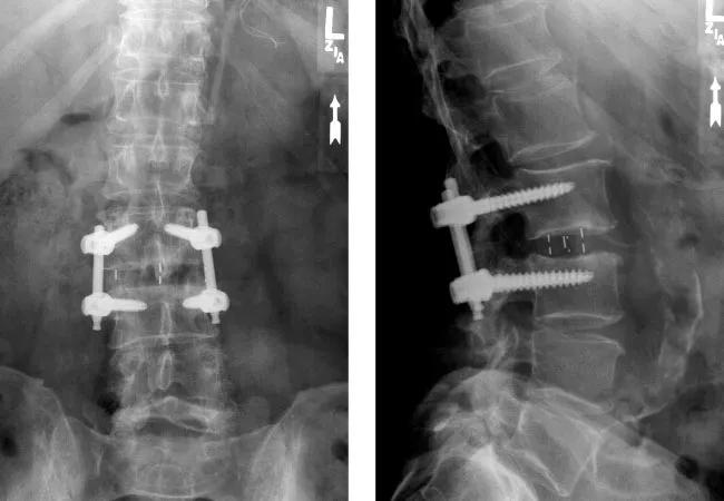 19-NEU-5571-lumbar-interbody-fusion-650&#215;450