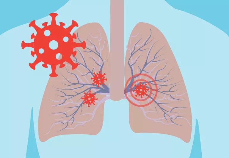 coronavirus and the lungs
