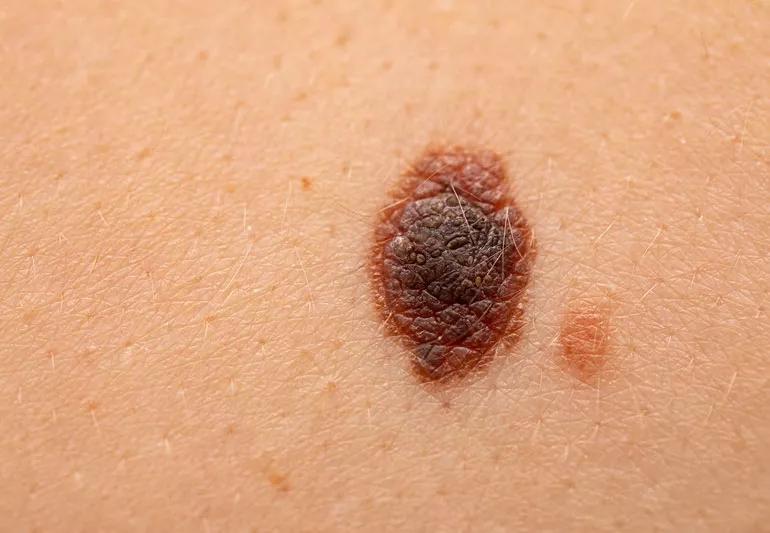 mole skin cancer