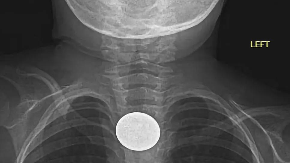 Anteroposterior X-ray showing swallowed coin