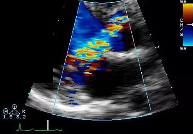 19-HRT-251-aortic-regurgitation-650&#215;450