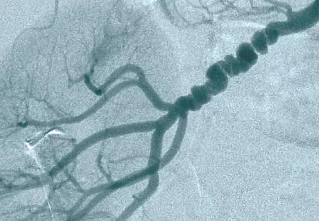 18-HRT-4821 Fibromuscular-Dysplasia-650&#215;450