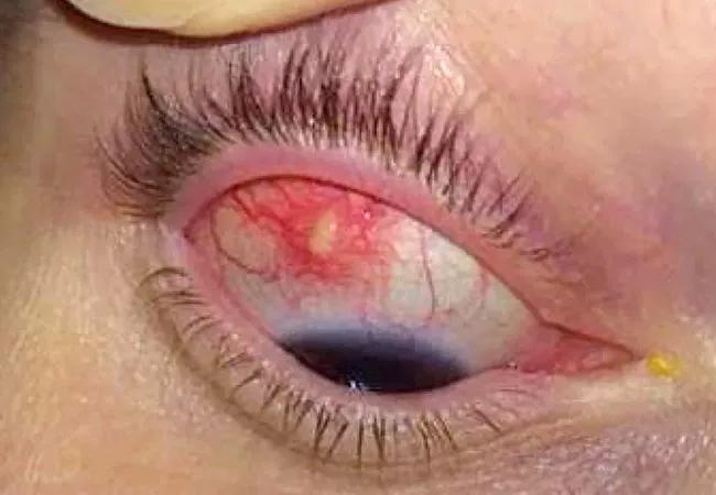 Nodular anterior scleritis in a patient with Behcet’s disease