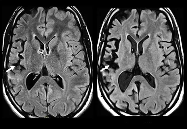 Rasmussen Encephalitis: Role of Immunotherapy and Timing of Epilepsy ...