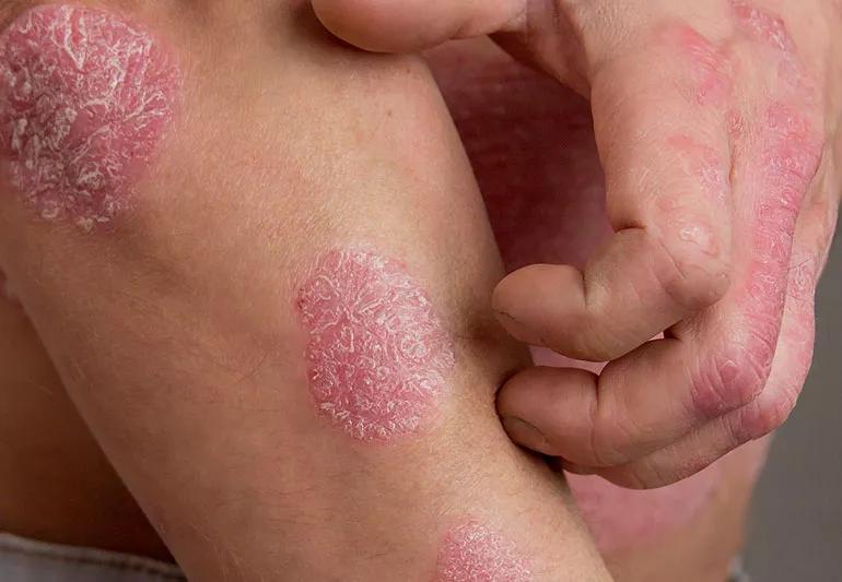 man scratching psoriasis outbreaks on skin