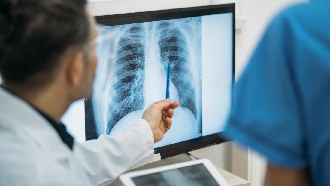 Doctor looking at chest x-ray