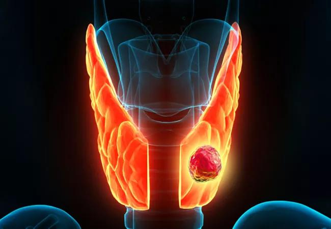 Thyroid nodule