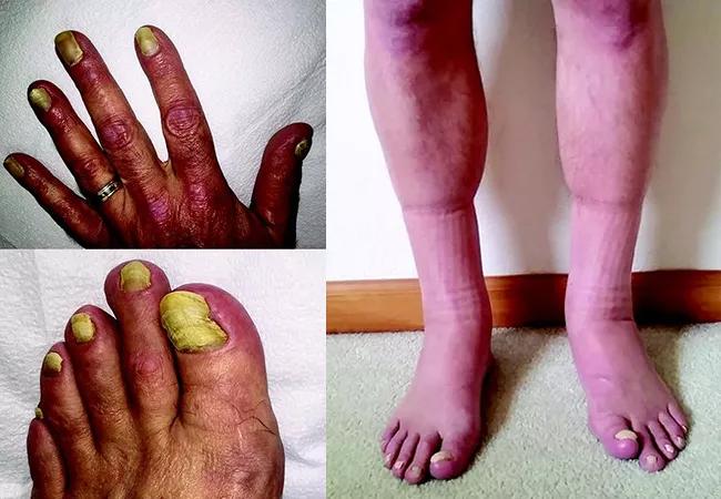 yellow nail syndrome