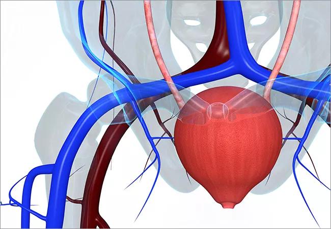 650&#215;450-Overactive-Bladder-Goldman