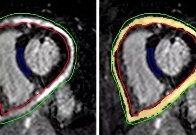 650&#215;450-Pericarditis