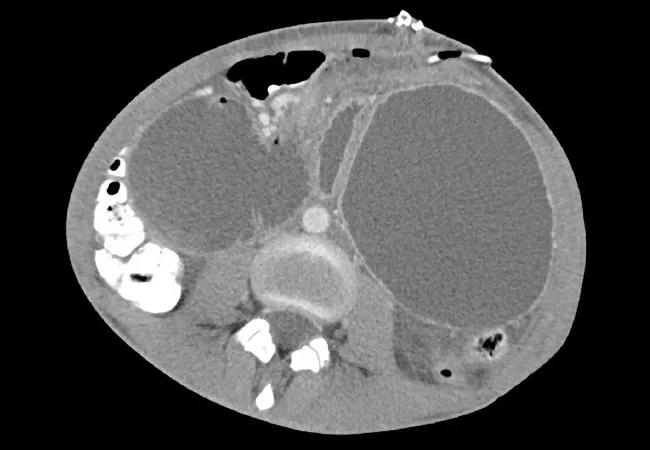 Cachectic Scleroderma Patient Recovers with Collaborative Management