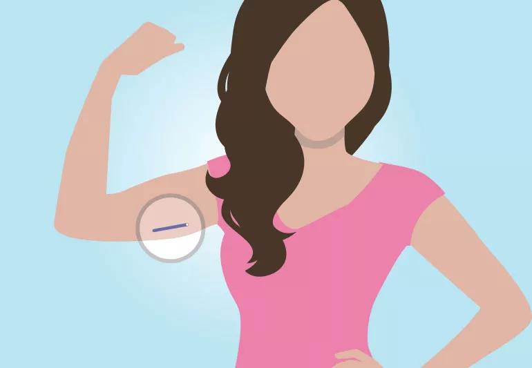Illustration of woman with birth control implant under upper arm