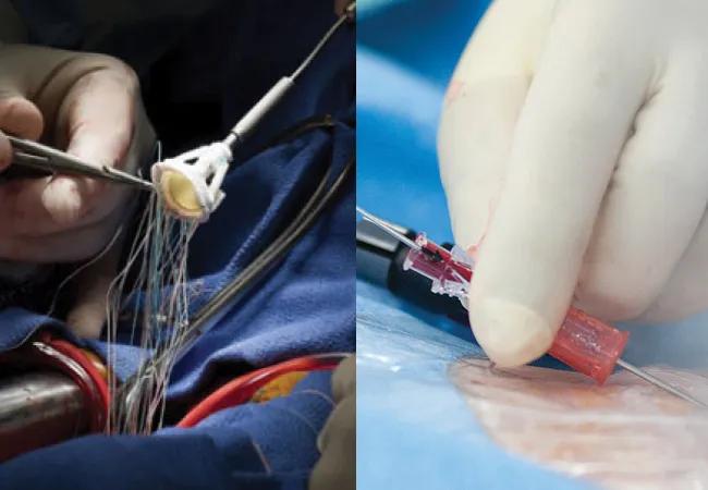 side-by-side photos of heart valve procedures