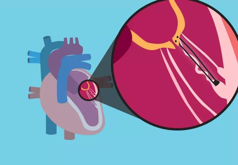 Mitral Valve chords shown in heart illustration