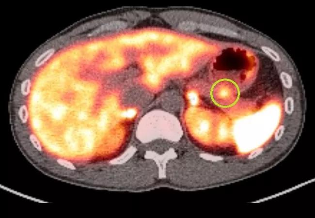 23-CCC-3907458 CC London neuroendocrine case report 650&#215;450